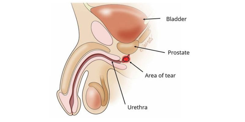 rapture-urethral-treatment-dr-aditya-sengar