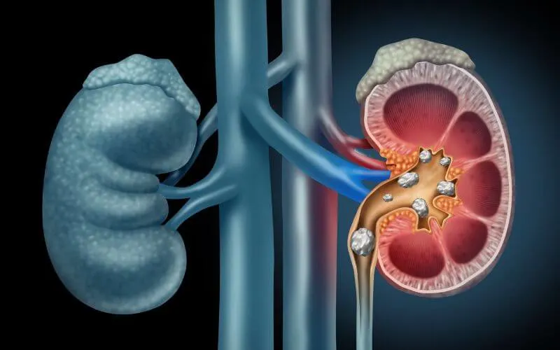 ureteric-stone-removal-services-provide-by-dr-aditya-sengar