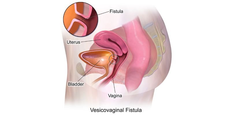 vesicovaginal-fistula-treatment-dr-aditya-sengar